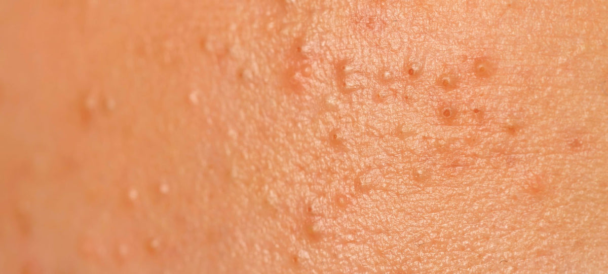 Complete Guide to Acne and Congested Skin – ID Skin