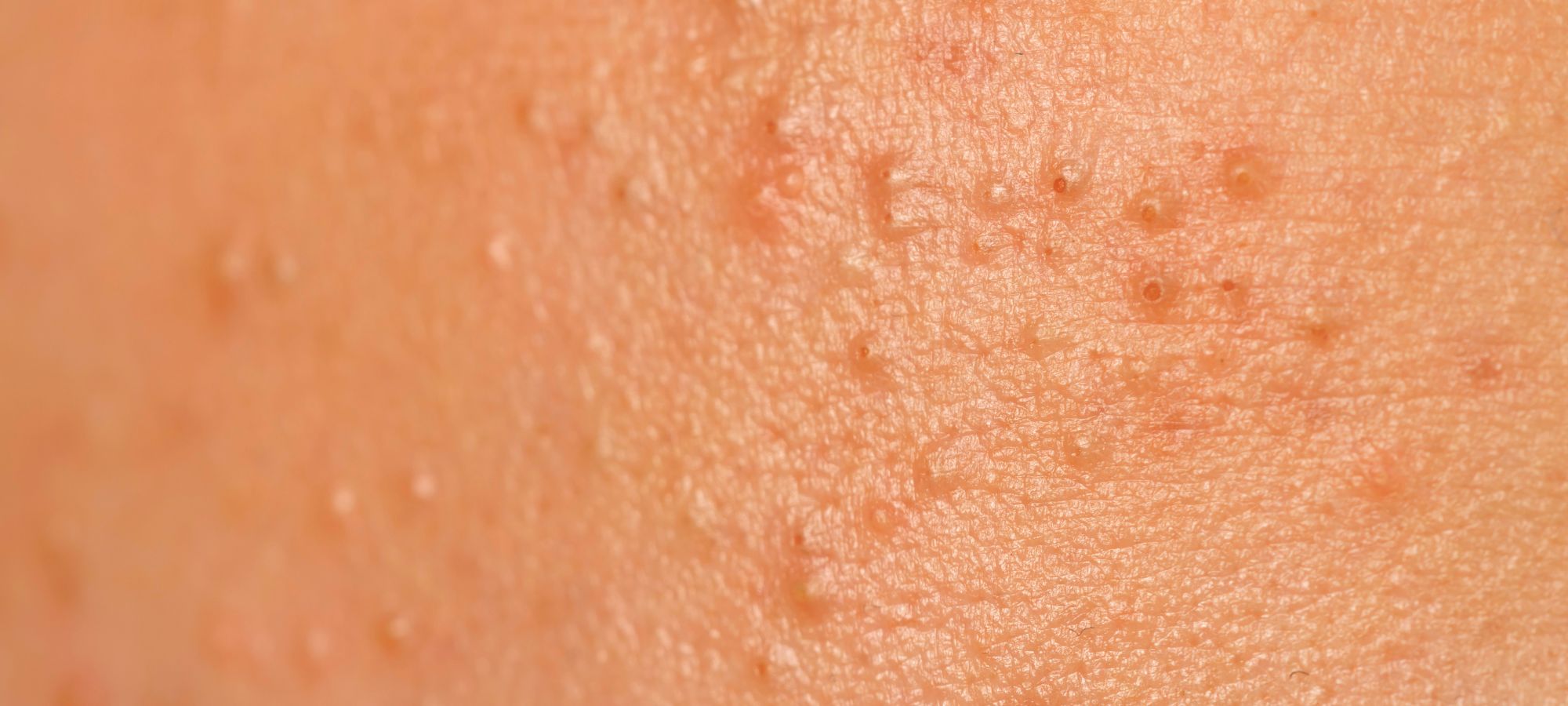 Complete Guide to Acne and Congested Skin